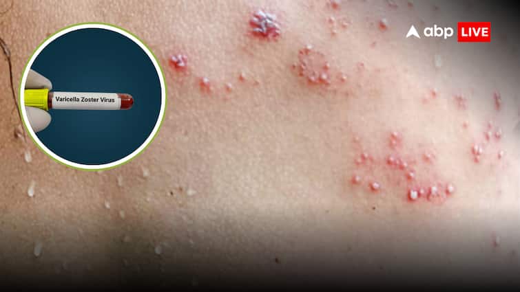 varicella zoster virus found 90 percent indian population become reason for shingles disease know symptoms prevention